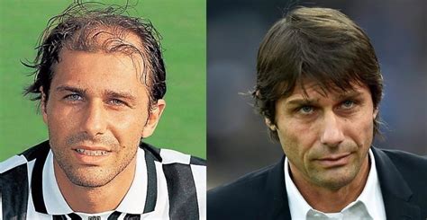 antonio conte hair transplant